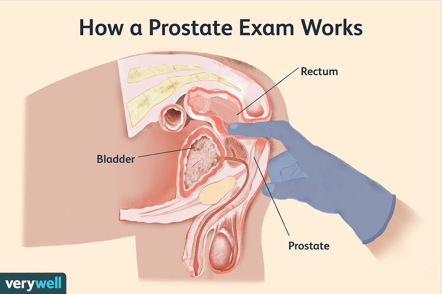 Exame de Próstata - Tire suas Dúvidas Aqui